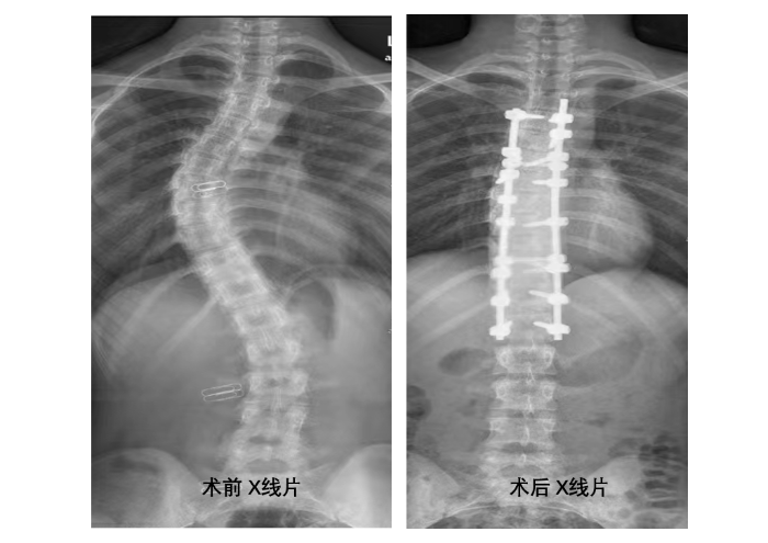 術(shù)前、術(shù)后x線片